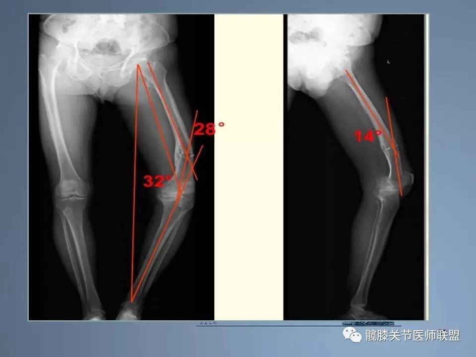 全膝关节置换术的手术流程和要点