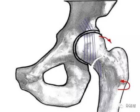 股骨颈骨不连的保髋治疗（一）