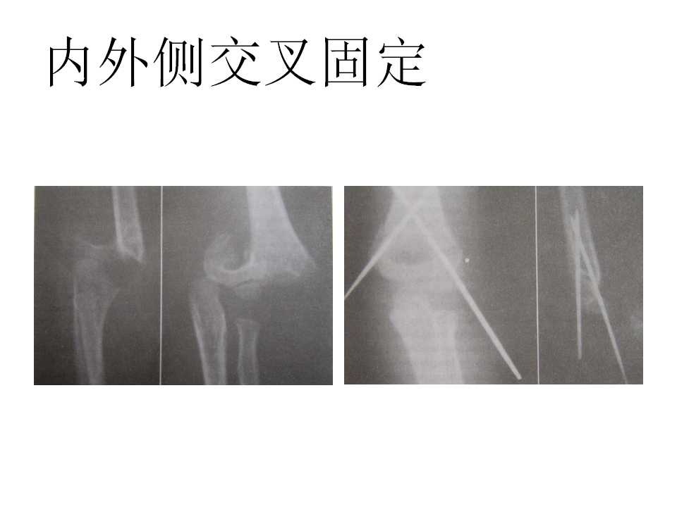 小儿肱骨髁上骨折的复位及治疗技巧