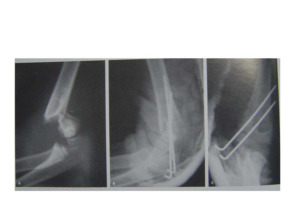 小儿肱骨髁上骨折的复位及治疗技巧