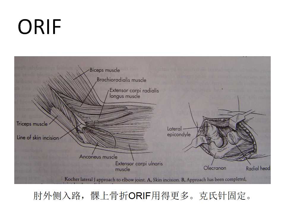 小儿肱骨髁上骨折的复位及治疗技巧