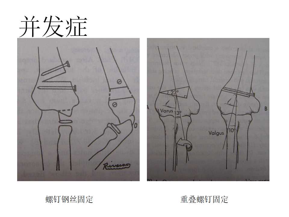 小儿肱骨髁上骨折的复位及治疗技巧