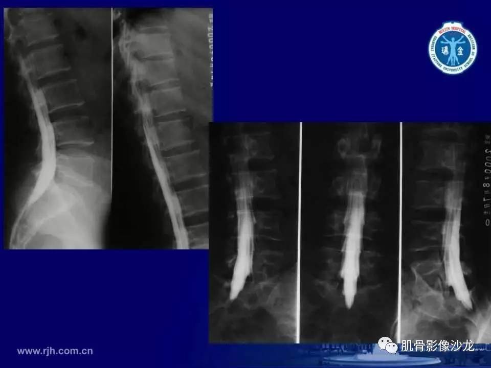 强直性脊柱炎的影像学诊断