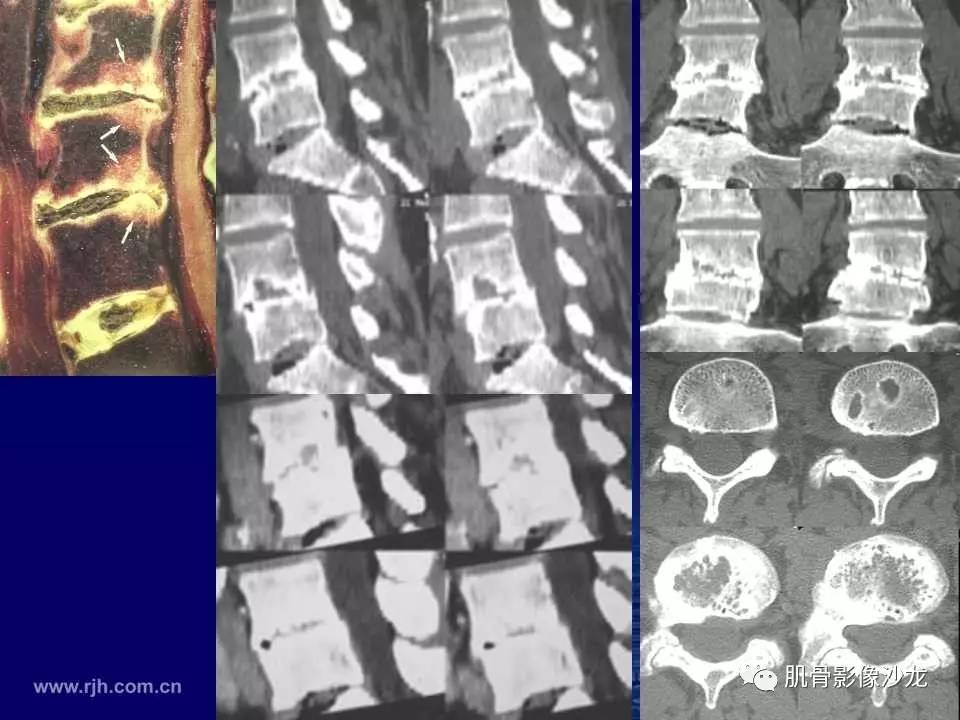 强直性脊柱炎的影像学诊断