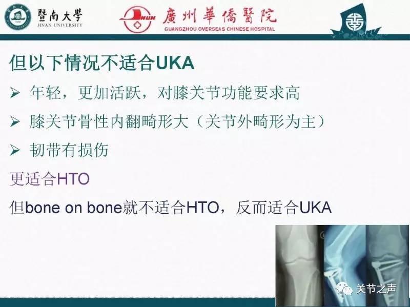 HTO珍“膝”治疗膝骨关节炎