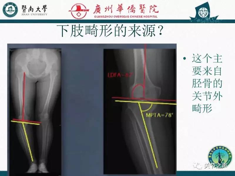 HTO珍“膝”治疗膝骨关节炎