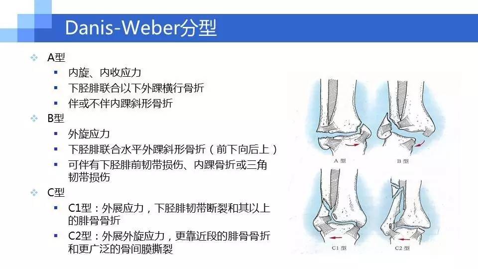 踝关节骨折的诊断与治疗策略