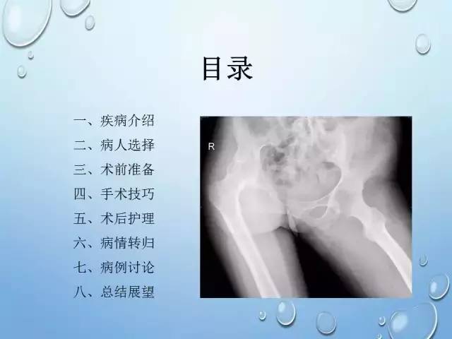 强直髋关节的人工关节置换技巧