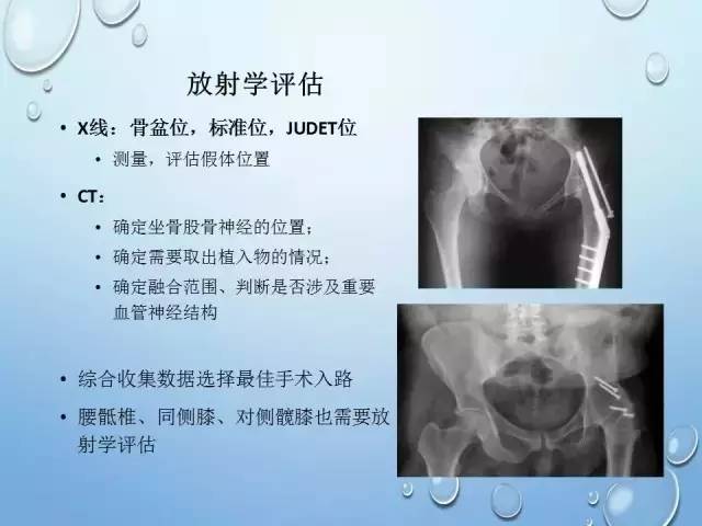 强直髋关节的人工关节置换技巧