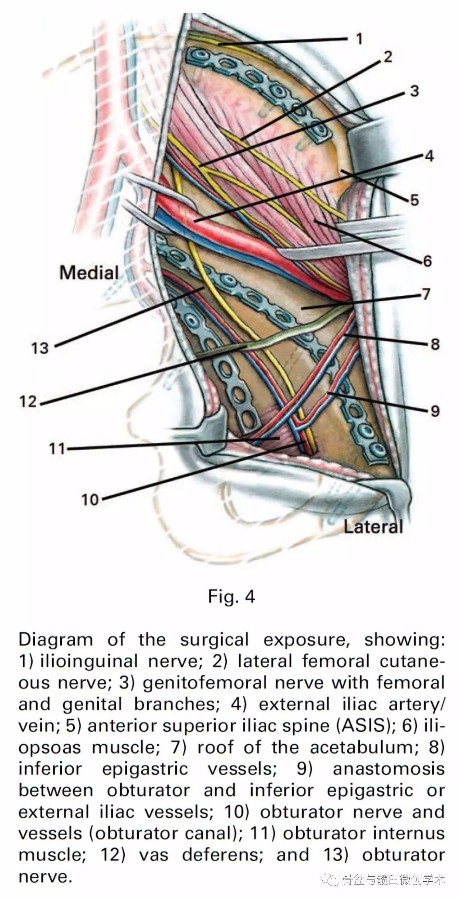 “前方骨盆内处理髋臼骨折”—腹直肌旁入路