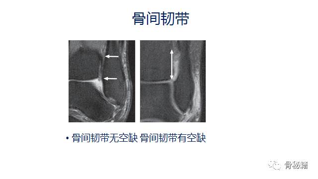 下胫腓韧带损伤的诊断