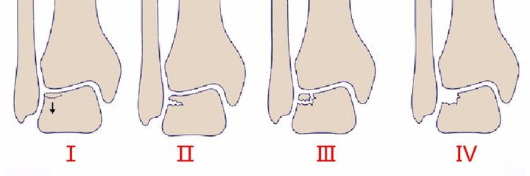距骨骨软骨损伤的分型图解