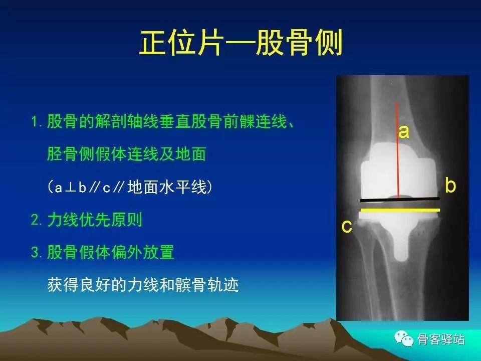 膝关节置换术后的X线评估