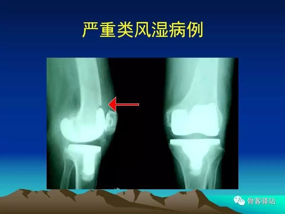 膝关节置换术后的X线评估