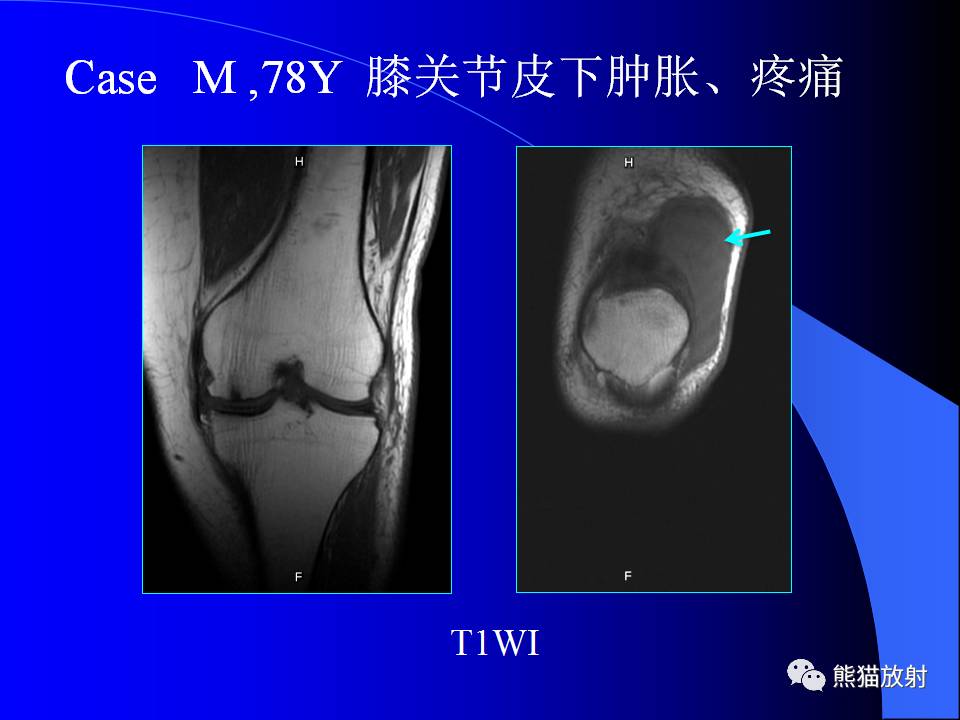 膝关节周围囊肿的MRI表现