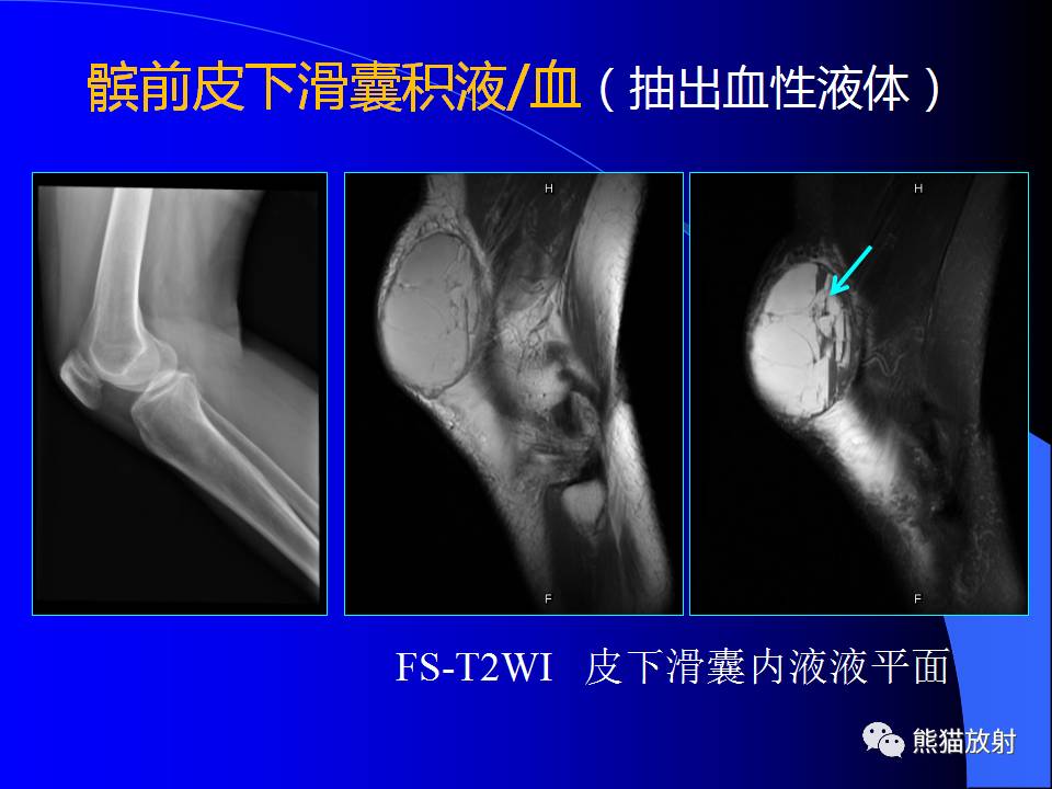 膝关节周围囊肿的MRI表现