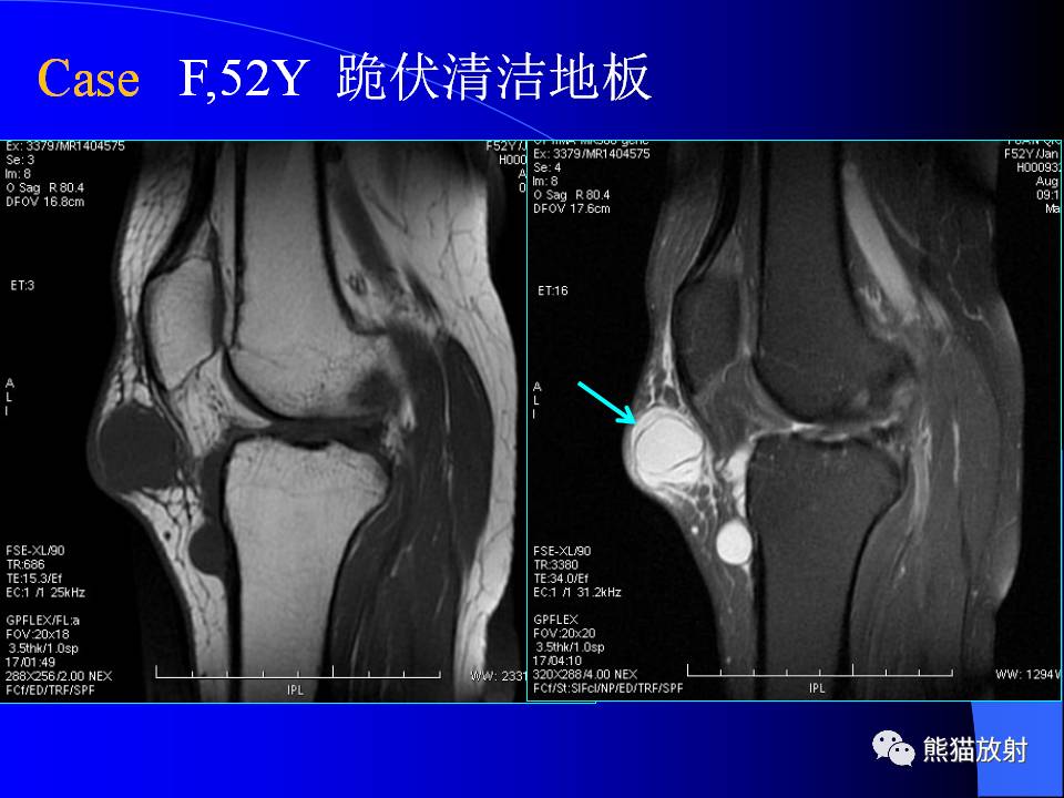 膝关节周围囊肿的MRI表现