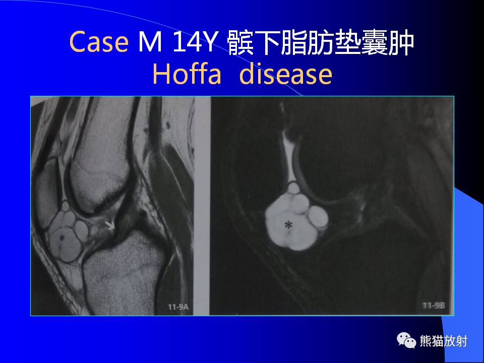 膝关节周围囊肿的MRI表现