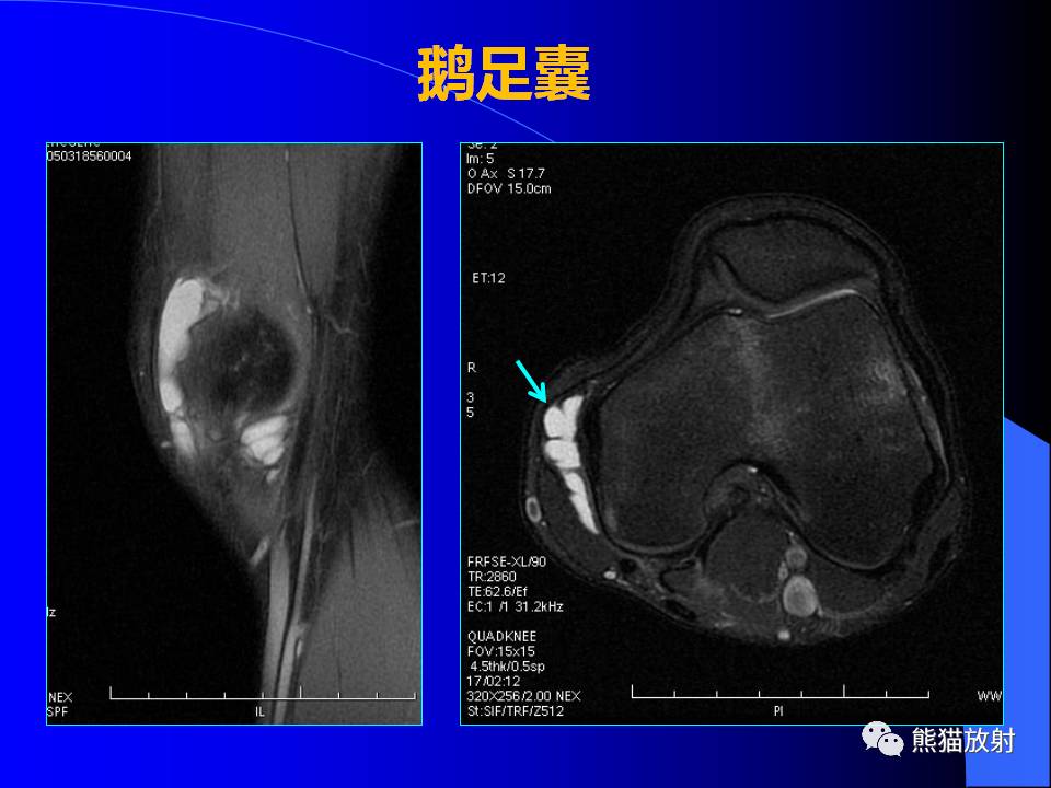 膝关节周围囊肿的MRI表现