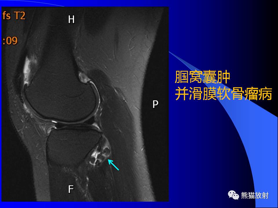 膝关节周围囊肿的MRI表现