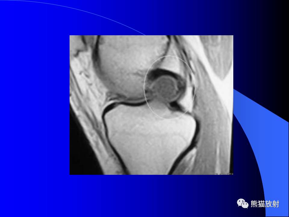 膝关节周围囊肿的MRI表现