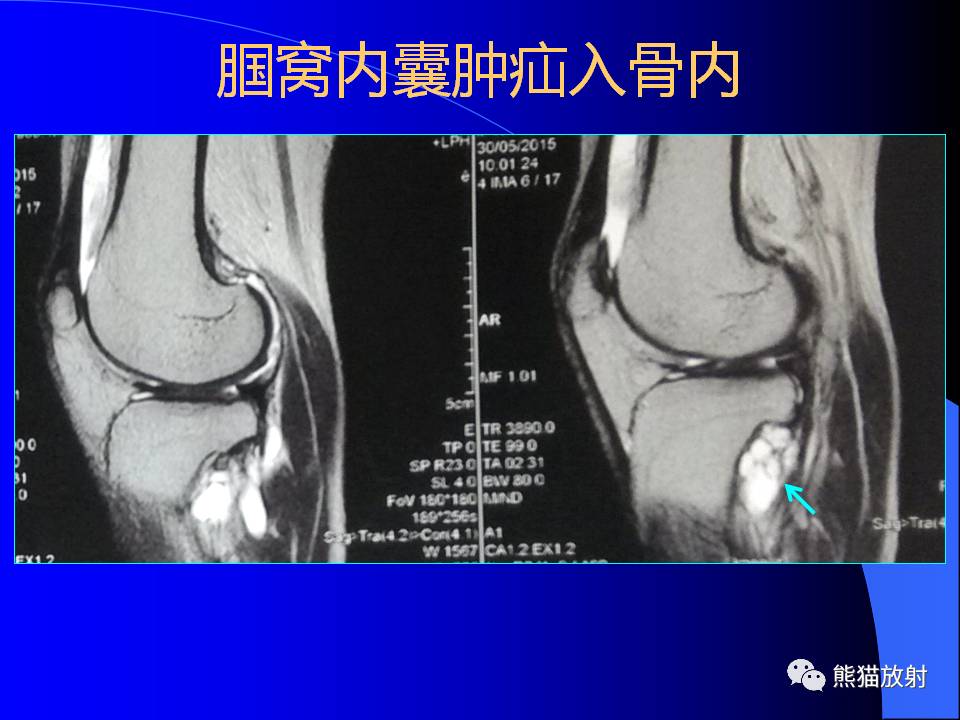 膝关节周围囊肿的MRI表现