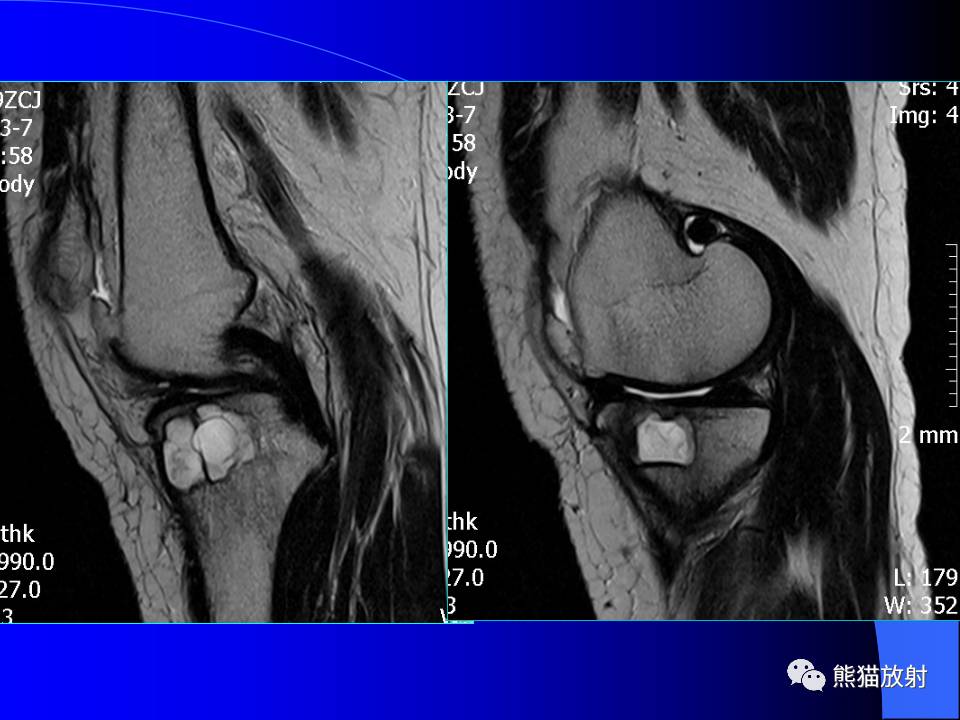 膝关节周围囊肿的MRI表现