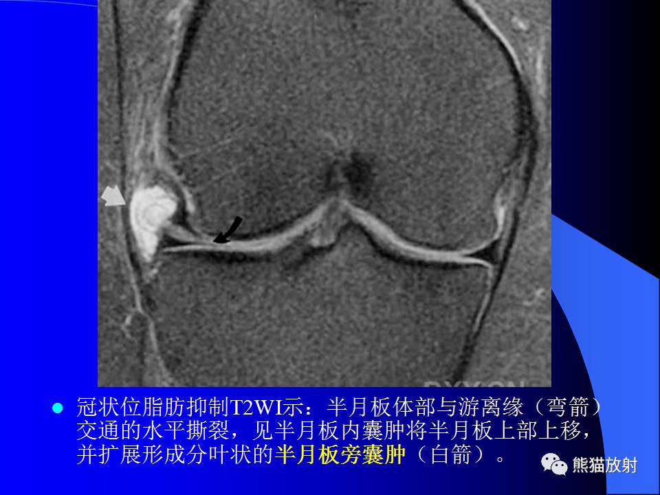 膝关节周围囊肿的MRI表现