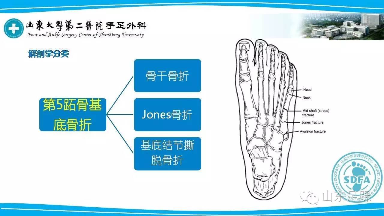 Jones骨折的分类及治疗方法