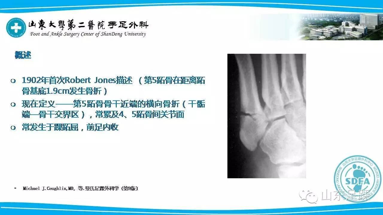 Jones骨折的分类及治疗方法