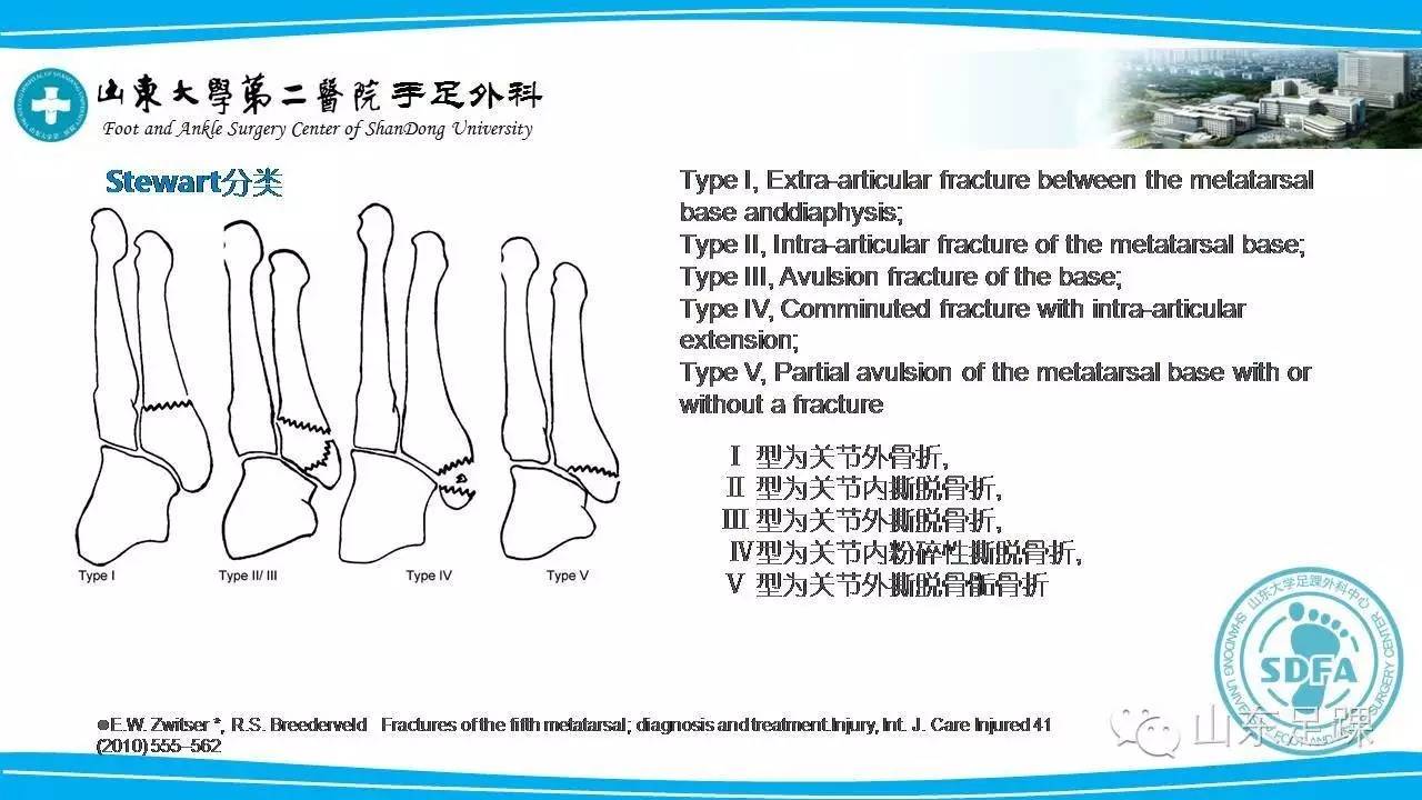 Jones骨折的分类及治疗方法