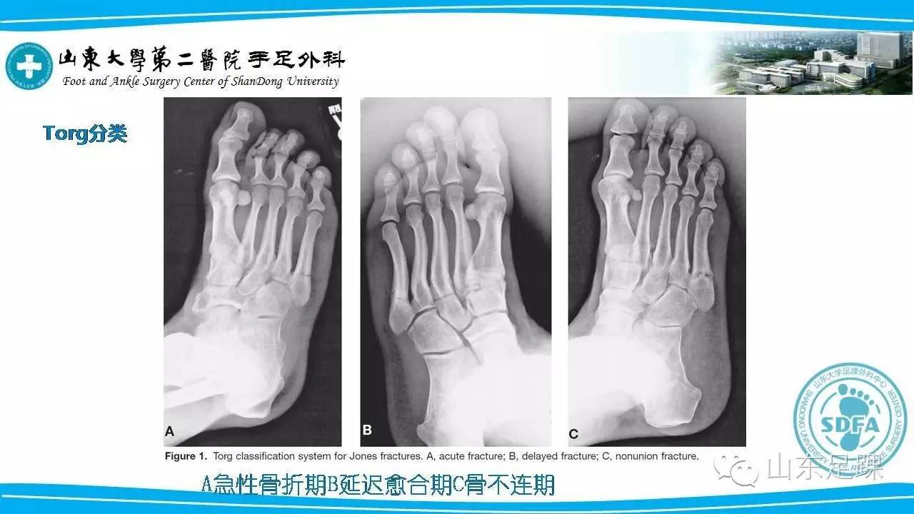 Jones骨折的分类及治疗方法