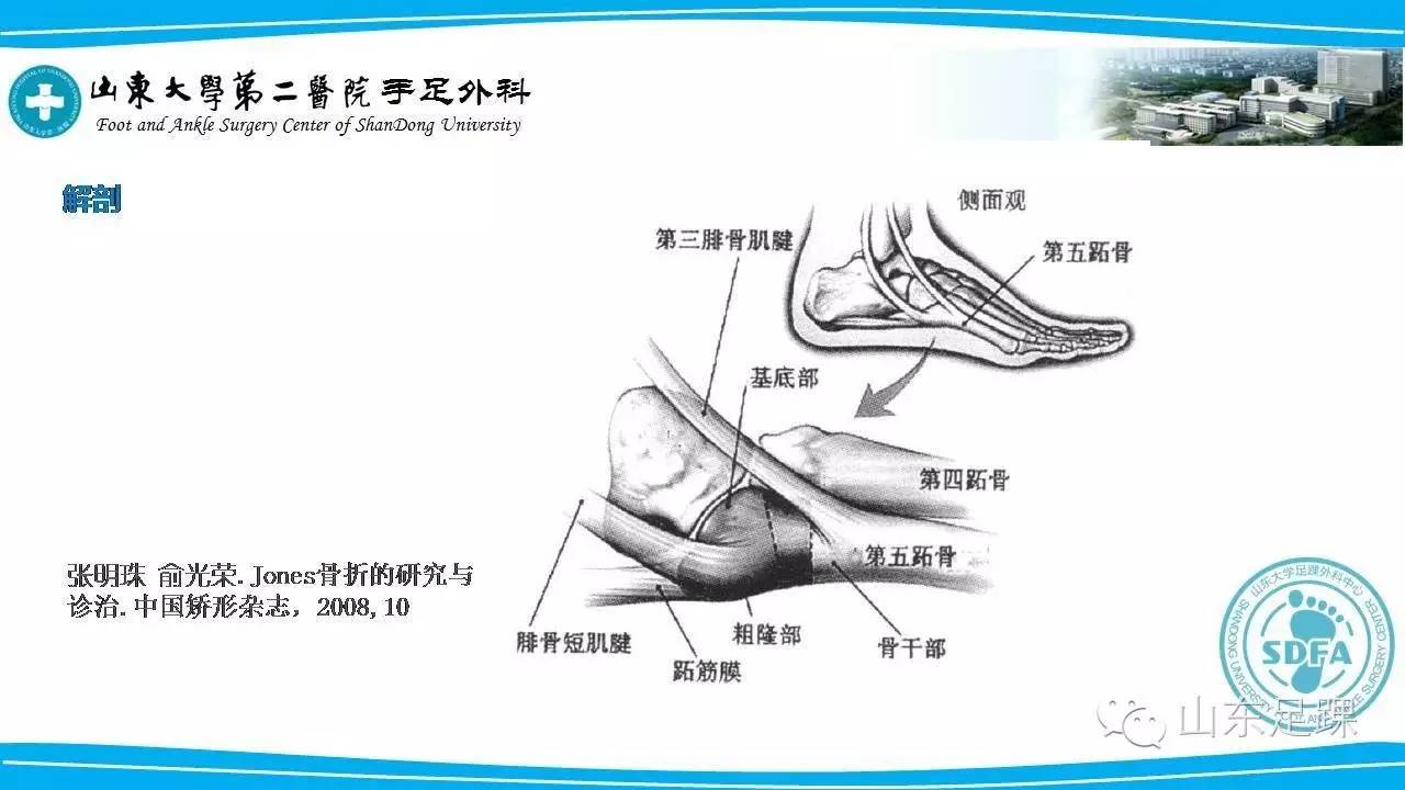 Jones骨折的分类及治疗方法