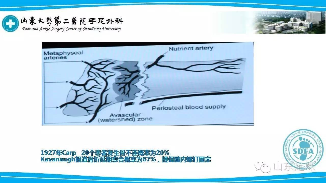 Jones骨折的分类及治疗方法