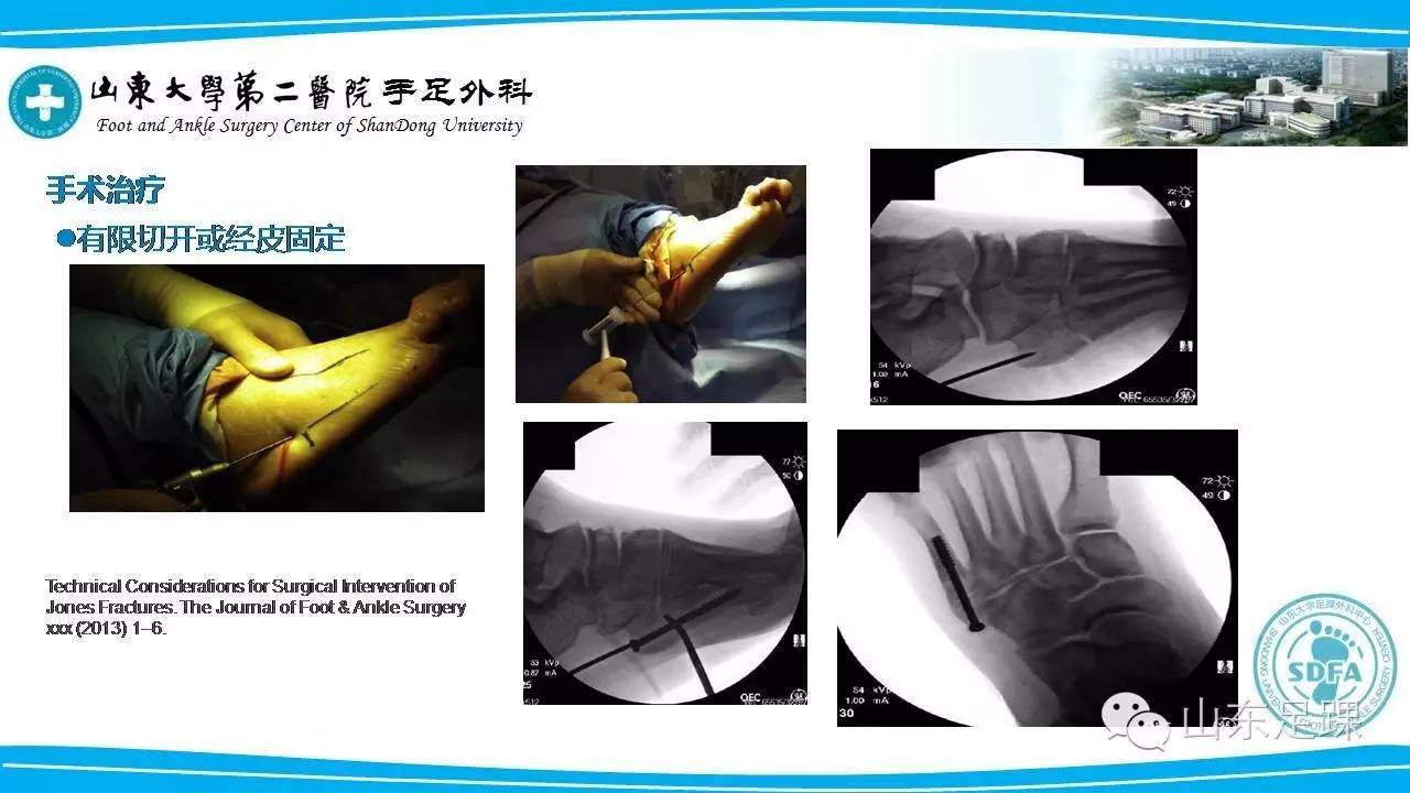Jones骨折的分类及治疗方法