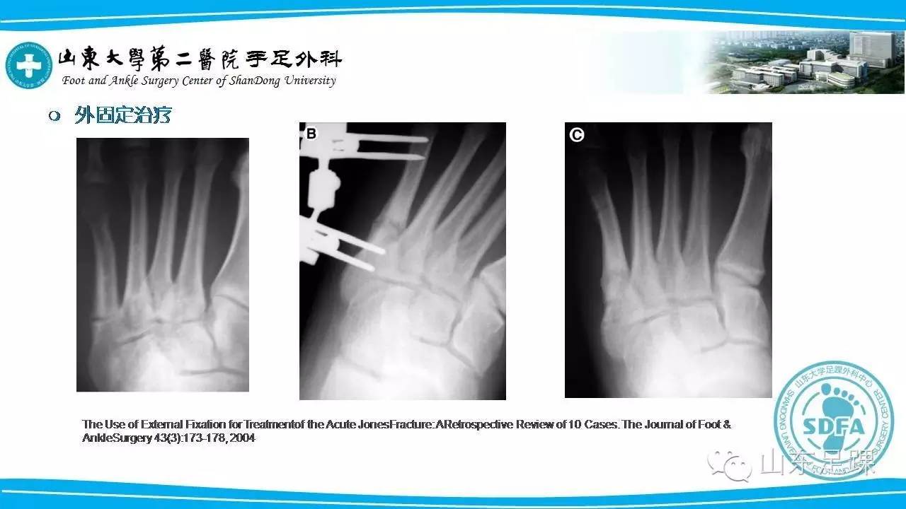 Jones骨折的分类及治疗方法