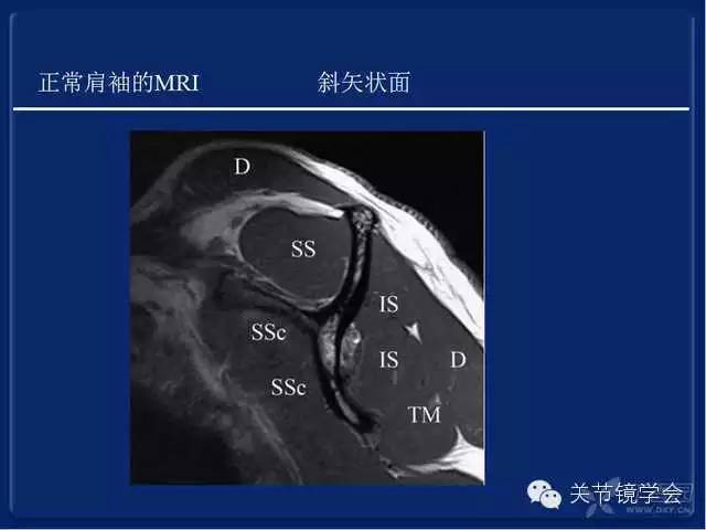 肩袖损伤的诊断与治疗策略