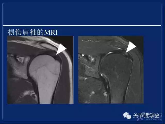 肩袖损伤的诊断与治疗策略