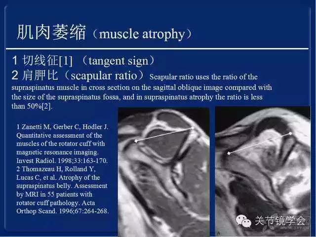 肩袖损伤的诊断与治疗策略