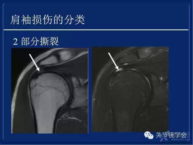 肩袖损伤的诊断与治疗策略