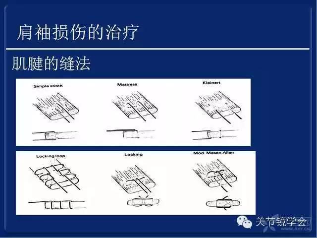 肩袖损伤的诊断与治疗策略