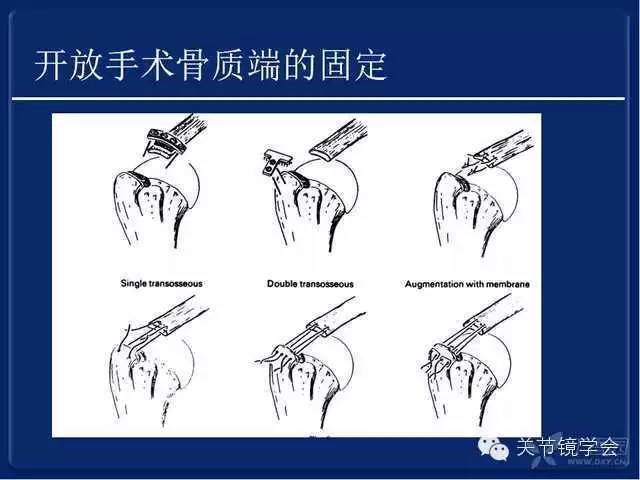 肩袖损伤的诊断与治疗策略