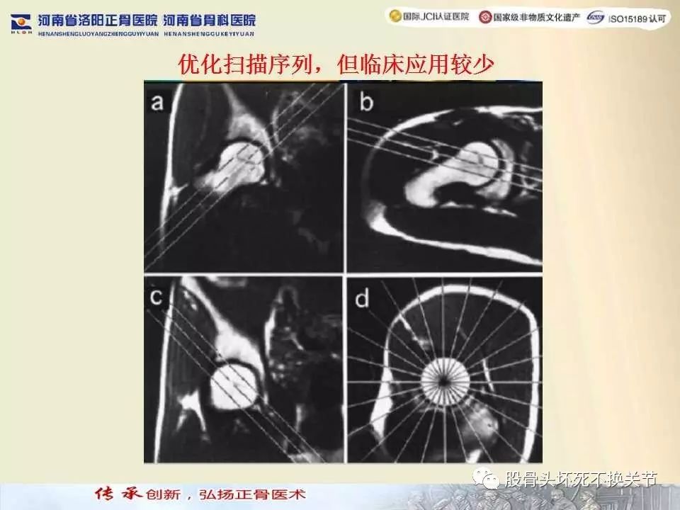 髋臼盂唇损伤的MRI诊断