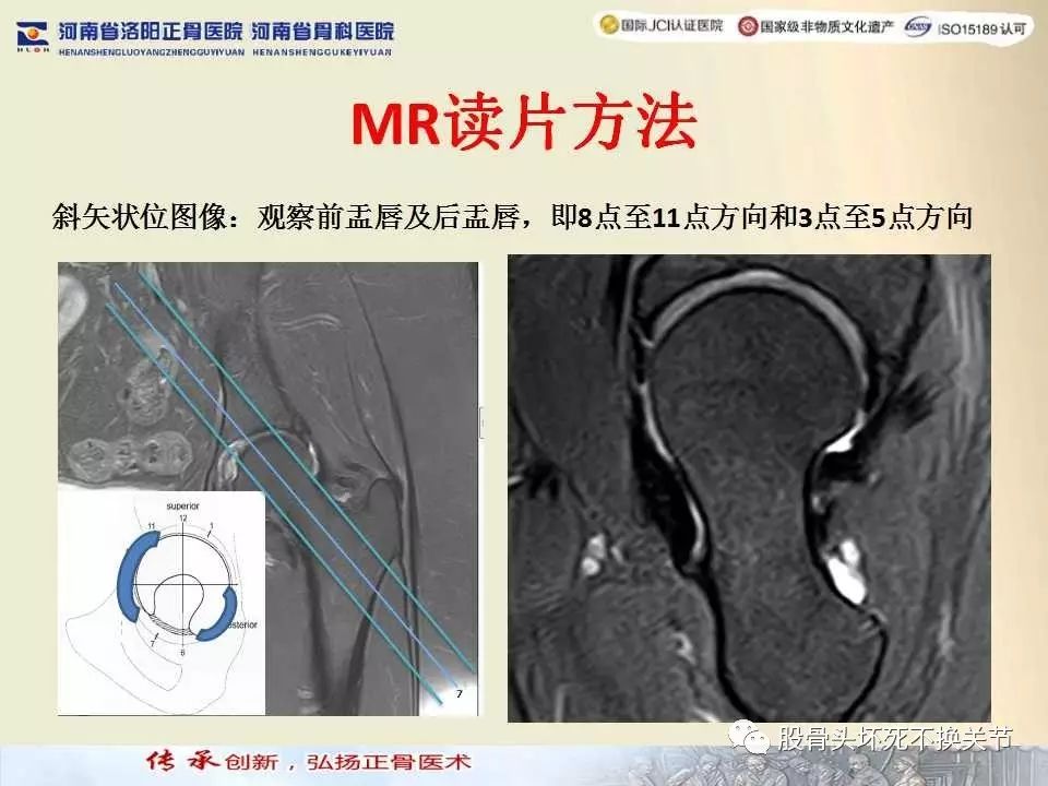 髋臼盂唇损伤的MRI诊断