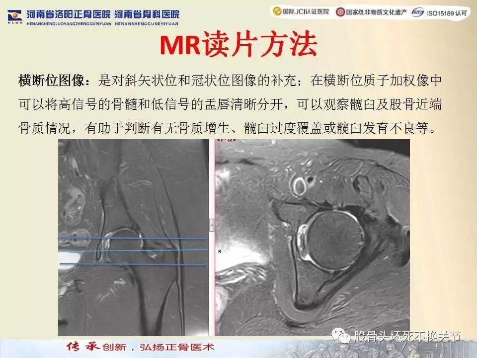 髋臼盂唇损伤的MRI诊断