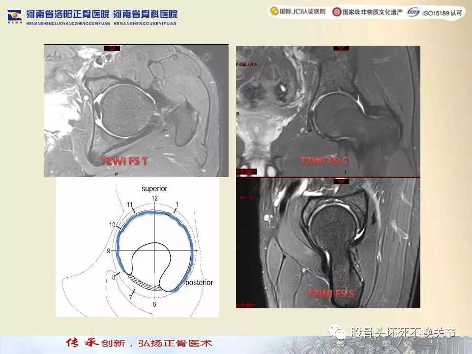 髋臼盂唇损伤的MRI诊断