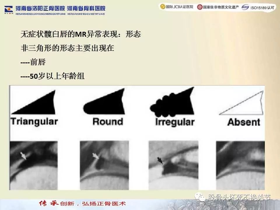 髋臼盂唇损伤的MRI诊断