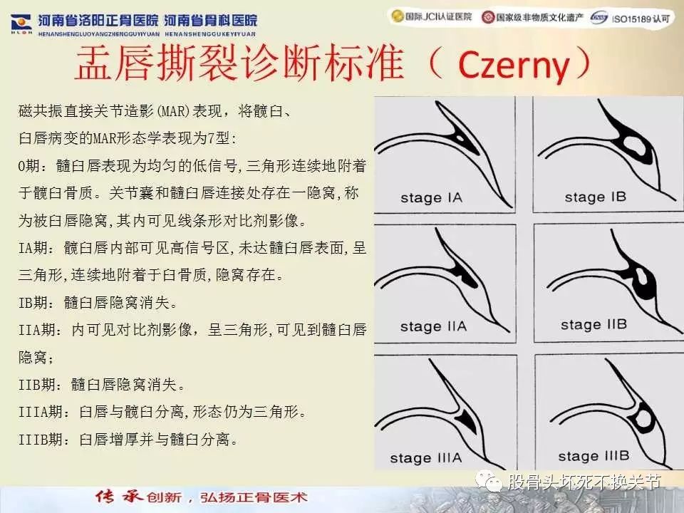 髋臼盂唇损伤的MRI诊断