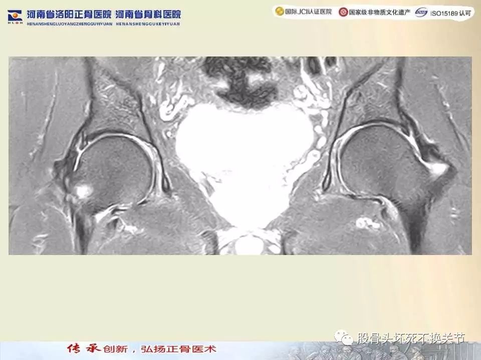 髋臼盂唇损伤的MRI诊断