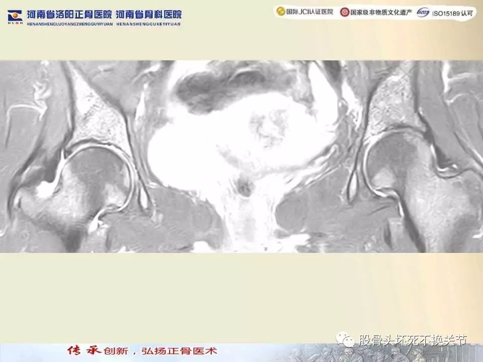 髋臼盂唇损伤的MRI诊断